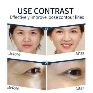 Advanced Portable Anti-Wrinkle Eye Bag Removal Device with Facial Lifting and Tightening Capability for Home and Professional Use